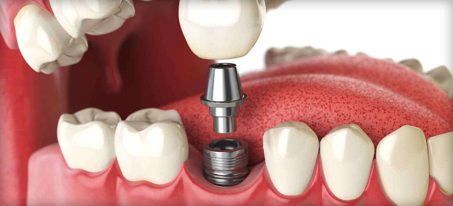 ourservices_implants